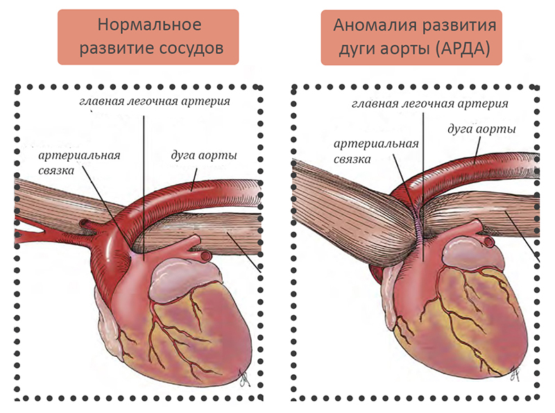Аномалия развития дуги аорты